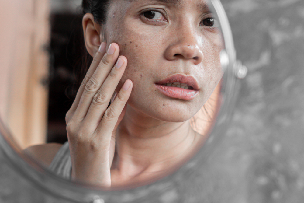 Melasma treatment for uneven skin tone